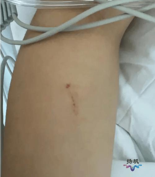 女子遭毒蛇咬伤身亡,女子遭毒蛇咬伤身亡视频