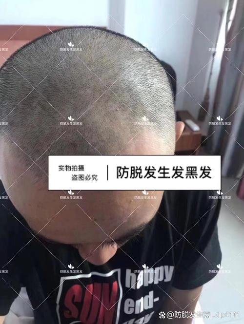 因发量太多剃掉头发,因发量太多剃掉头发会怎么样
